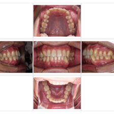 蒲田（矢口渡）のマウスピース矯正（インビザライン矯正）｜のびのび歯科・矯正歯科の治療症例