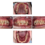蒲田（矢口渡）のマウスピース矯正（インビザライン矯正）｜のびのび歯科・矯正歯科の治療症例