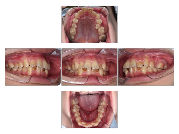蒲田（矢口渡）のマウスピース矯正（インビザライン矯正）｜のびのび歯科・矯正歯科の治療症例