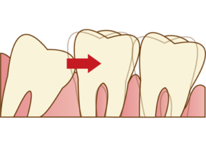 蒲田の矯正歯科、のびのび歯科・矯正歯科で親知らずがある場合の矯正治療